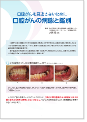 口腔がんの病態と鑑別