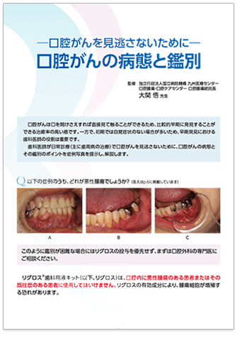 口腔がんの病態と鑑別